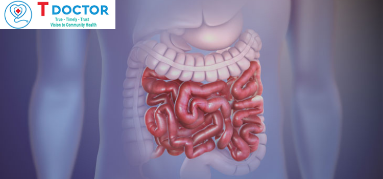Tắc ruột là gì? Giải đáp từ chuyên gia